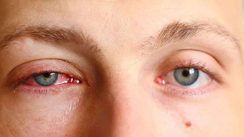Biểu hiện của triệu chứng “Arc Eye” - Viêm kết mạc do bức xạ hàn