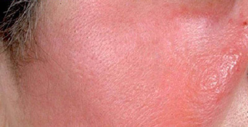 Tiếp xúc với hồ quang hàn có gây tác hại đến da không?